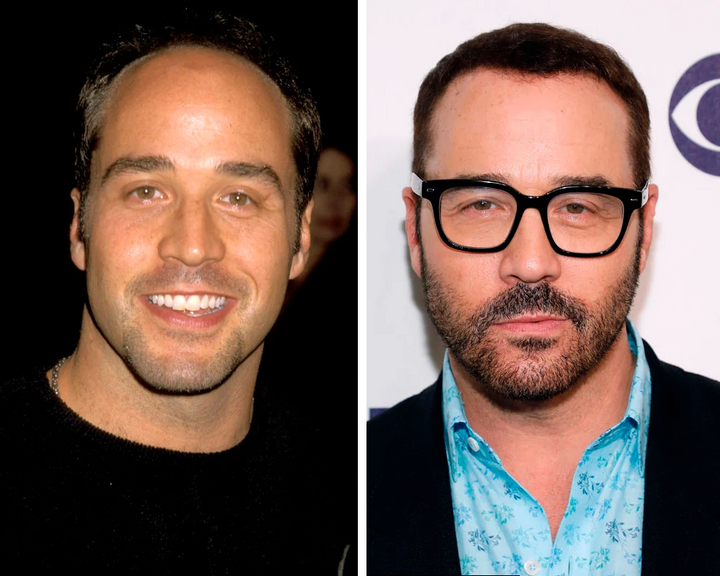 trasplante de cabello jeremy piven